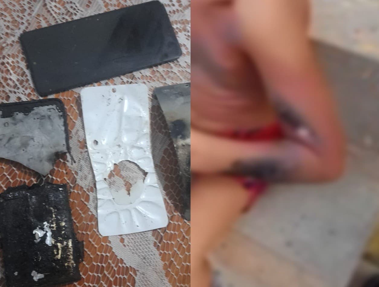Criança de 6 anos sofre queimaduras graves após explosão de celular no Recife