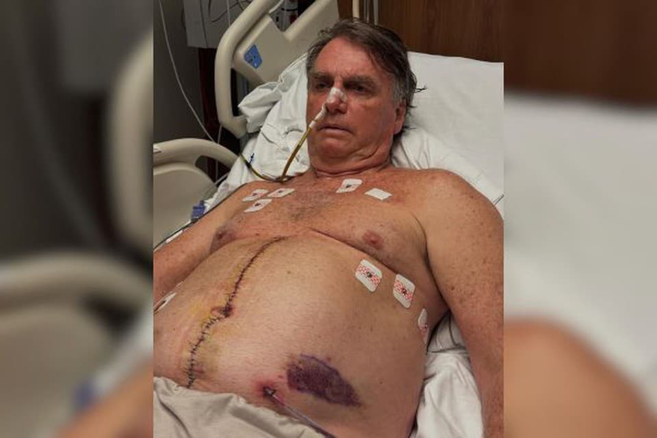 Bolsonaro completa uma semana internado e compartilha foto de pontos no abdômen